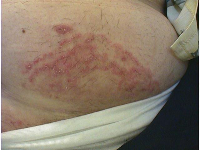 SUPERFICIAL FUNGAL INFECTIONS - Tinea corporis due to trichophyton SUPERFICIAL FUNGAL INFECTIONS - Tinea corporis due to trichophyton
