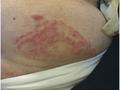 SUPERFICIAL FUNGAL INFECTIONS - Tinea corporis due to trichophyton