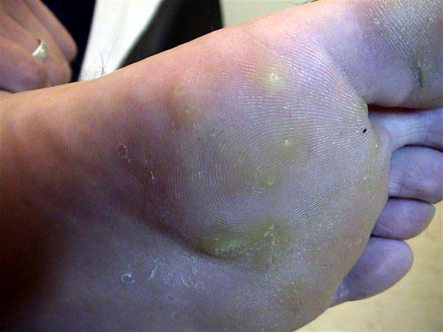 VIRAL INFECTIONS - Warts VIRAL INFECTIONS - Warts
