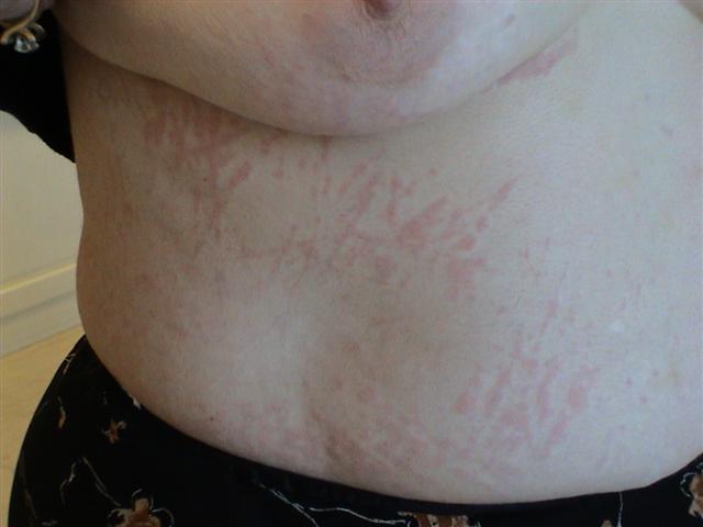 URTICARIA - Urticaria