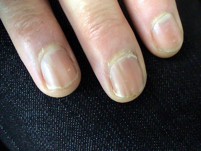 NAIL DISEASES - Melanonychia longitudinal NAIL DISEASES - Melanonychia longitudinal
