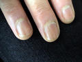 NAIL DISEASES - Melanonychia longitudinal
