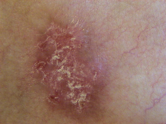CONNECTIVE TISSUE DISORDERS - Discoid lupus erythematosus CONNECTIVE TISSUE DISORDERS - Discoid lupus erythematosus