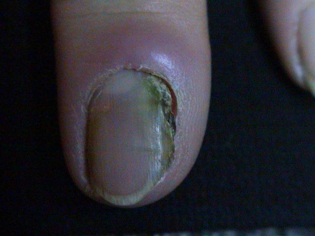 NAIL DISEASES - Onychomycosis