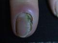 NAIL DISEASES - Onychomycosis