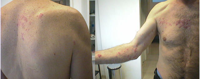 VIRAL INFECTIONS - Herpes Zoster VIRAL INFECTIONS - Herpes Zoster