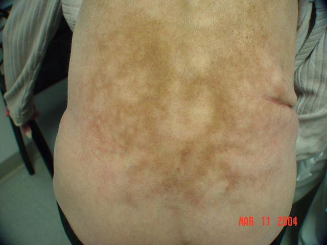 REACTIONS TO HEAT, COLD AND LIGHT - Erythema ab igne REACTIONS TO HEAT, COLD AND LIGHT - Erythema ab igne