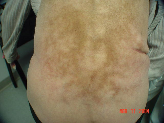 REACTIONS TO HEAT, COLD AND LIGHT - Erythema ab igne