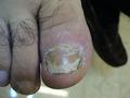 NAIL DISEASES - Onychomycosis due to Tr. rubrum infection