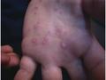 VIRAL INFECTIONS - Hand, foot and mouth disease