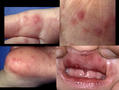 VIRAL INFECTIONS - Hand, foot and mouth disease