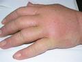 DERMATITIS - EKZEMA - Dermatitis