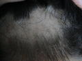 HAIR DISEASES - Trichotillomania