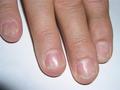 NAIL DISEASES - Lichen planus of the nails