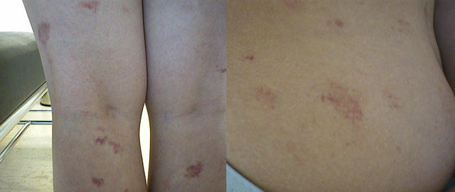 VARIOUS or of UNKNOWN ETIOLOGY DISEASES - Pityriasis rosea VARIOUS or of UNKNOWN ETIOLOGY DISEASES - Pityriasis rosea