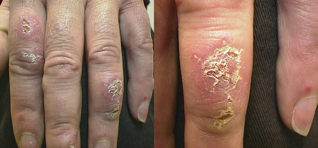 CONNECTIVE TISSUE DISORDERS - Discoid lupus erythematosus