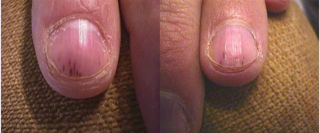 NAIL DISEASES - Splinter haemorrhages