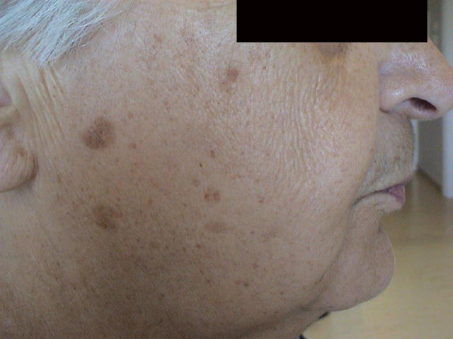 CONNECTIVE TISSUE DISORDERS - Photoaging CONNECTIVE TISSUE DISORDERS - Photoaging