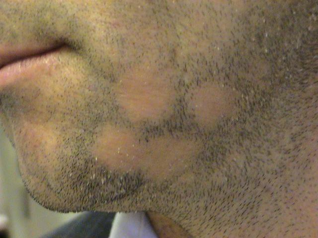 HAIR DISEASES - Alopecia Areata HAIR DISEASES - Alopecia Areata