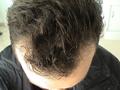 HAIR DISEASES - Androgenetic alopecia