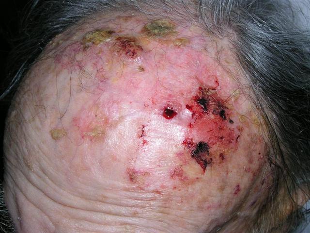 MALIGNANT LESIONS - Squamous Cell Carcinoma (SCC)