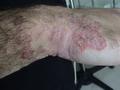 DERMATITIS - EKZEMA - Infected eczema