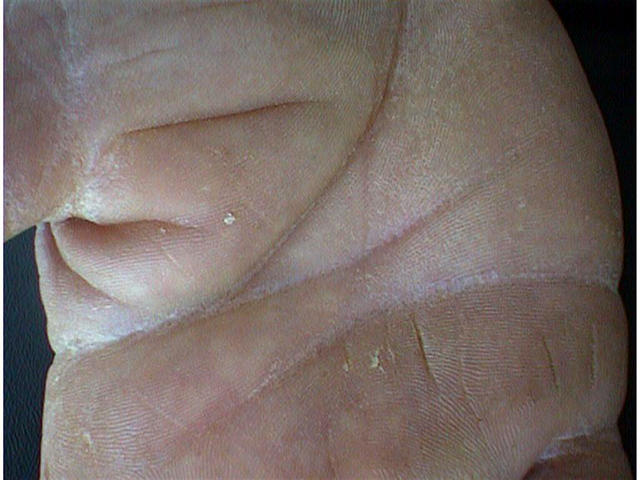 SUPERFICIAL FUNGAL INFECTIONS - Tinea mannum