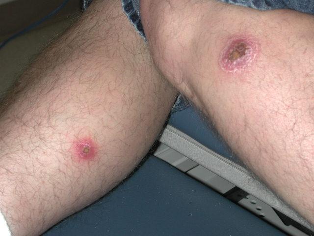 PARASITOSES, BITES - Cutaneous leishmaniasis