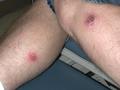 PARASITOSES, BITES - Cutaneous leishmaniasis