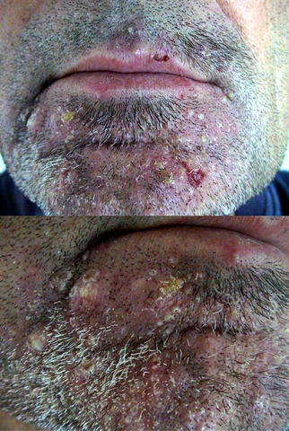 BACTERIAL INFECTIONS - Sycosis due to Staphylococcus BACTERIAL INFECTIONS - Sycosis due to Staphylococcus