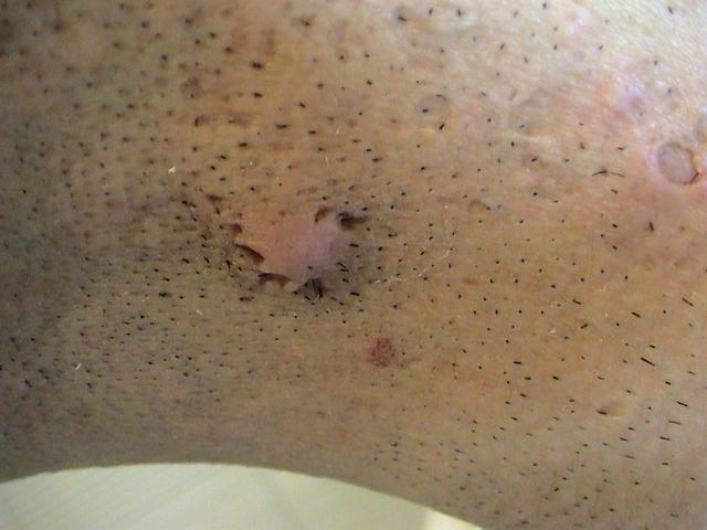 CONNECTIVE TISSUE DISORDERS - Acne, Atrophic and Hypertrophic scars CONNECTIVE TISSUE DISORDERS - Acne, Atrophic and Hypertrophic scars