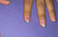 DRUG ERUPTIONS - Nail pigmentation due to tetracycline