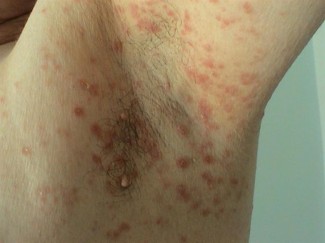 VARIOUS or of UNKNOWN ETIOLOGY DISEASES - Pityriasis rosea VARIOUS or of UNKNOWN ETIOLOGY DISEASES - Pityriasis rosea
