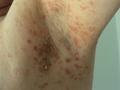 VARIOUS or of UNKNOWN ETIOLOGY DISEASES - Pityriasis rosea