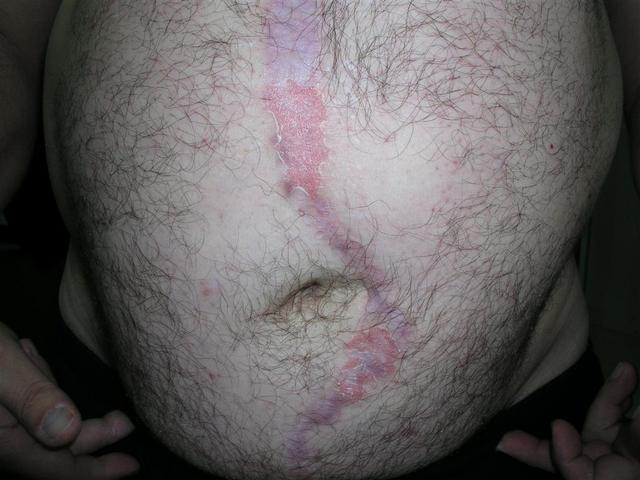 PSORIASIS - Psoriasis, Keobner phenomenon PSORIASIS - Psoriasis, Keobner phenomenon