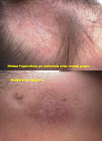 CONNECTIVE TISSUE DISORDERS - Morphea CONNECTIVE TISSUE DISORDERS - Morphea