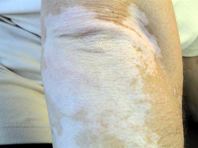 PIGMENTATION DISORDERS - Vitiligo PIGMENTATION DISORDERS - Vitiligo