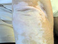 PIGMENTATION DISORDERS - Vitiligo