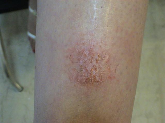 DERMATITIS - EKZEMA - Nummular eczema DERMATITIS - EKZEMA - Nummular eczema