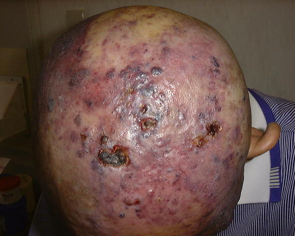 MALIGNANT LESIONS - Angiosarcoma