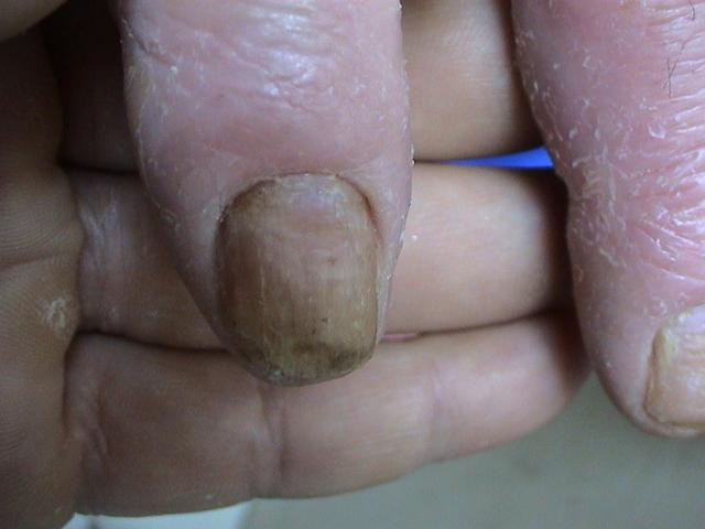 PSORIASIS - Psoriatic nails