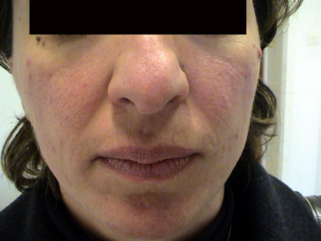 DISEASES OF THE SEBACEOUS GLANDS - Rosacea