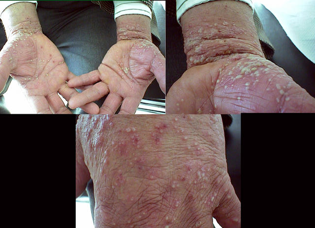 VARIOUS or of UNKNOWN ETIOLOGY DISEASES - Acropustulosis VARIOUS or of UNKNOWN ETIOLOGY DISEASES - Acropustulosis