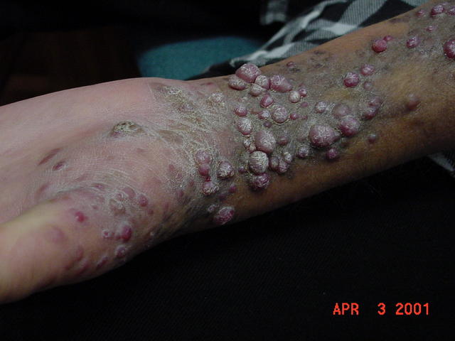 SKIN LESIONS IN HIV-AIDS PATIENTS - HIV Kaposi