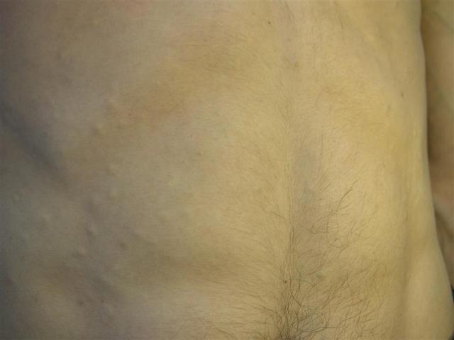 Various Or Of Unknown Etiology Diseases Eruptive Vellus Hair