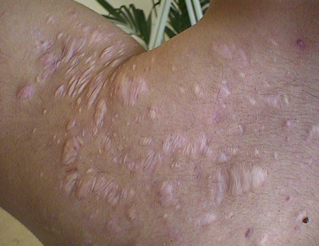 CONNECTIVE TISSUE DISORDERS - Post-acne, hypertrophic scars