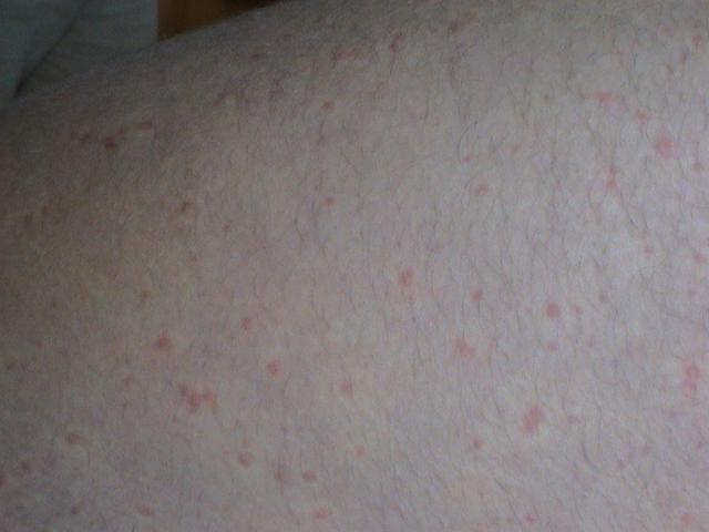 URTICARIA - Cholinergic urticaria URTICARIA - Cholinergic urticaria