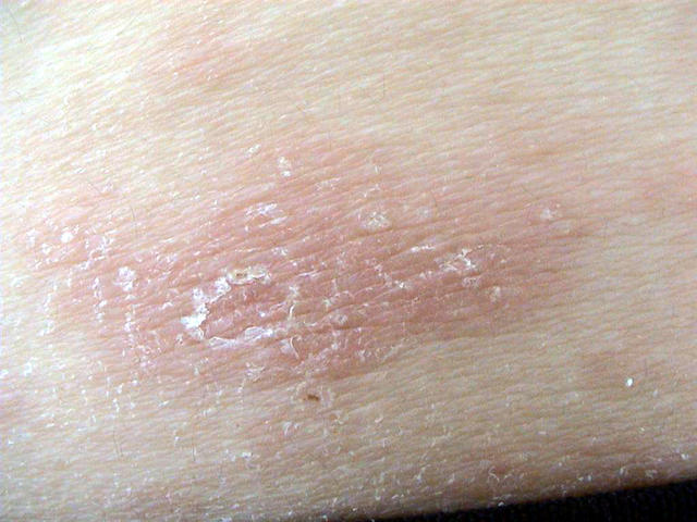 VARIOUS or of UNKNOWN ETIOLOGY DISEASES - Pityriasis rosea VARIOUS or of UNKNOWN ETIOLOGY DISEASES - Pityriasis rosea