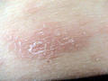 VARIOUS or of UNKNOWN ETIOLOGY DISEASES - Pityriasis rosea