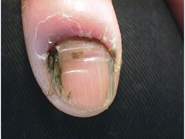 NAIL DISEASES - Onychomycosis due to Candida albicans infection